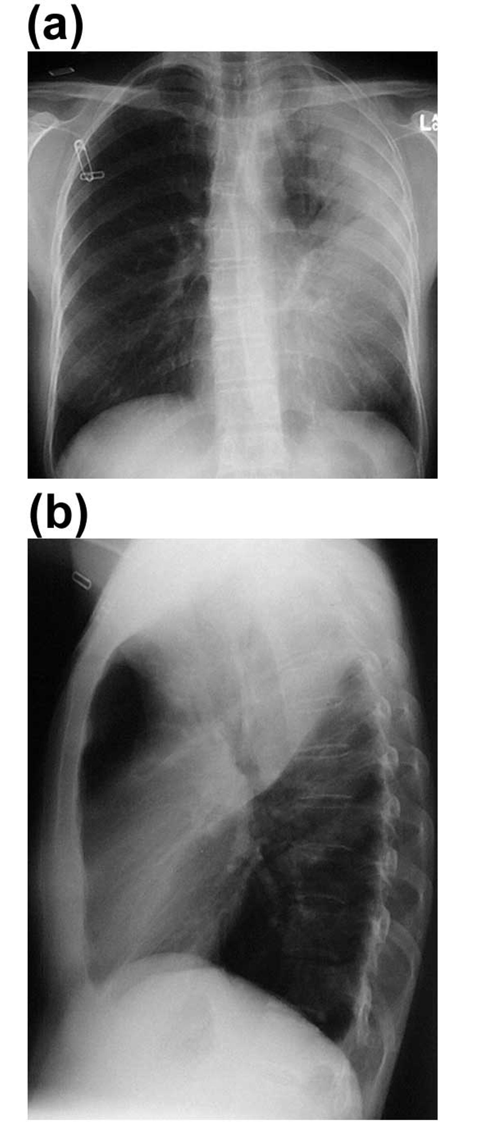 LEFT UPPER LOBE PNEUMONIA