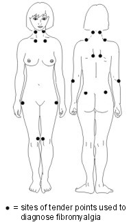 Fibromyalgia tender points