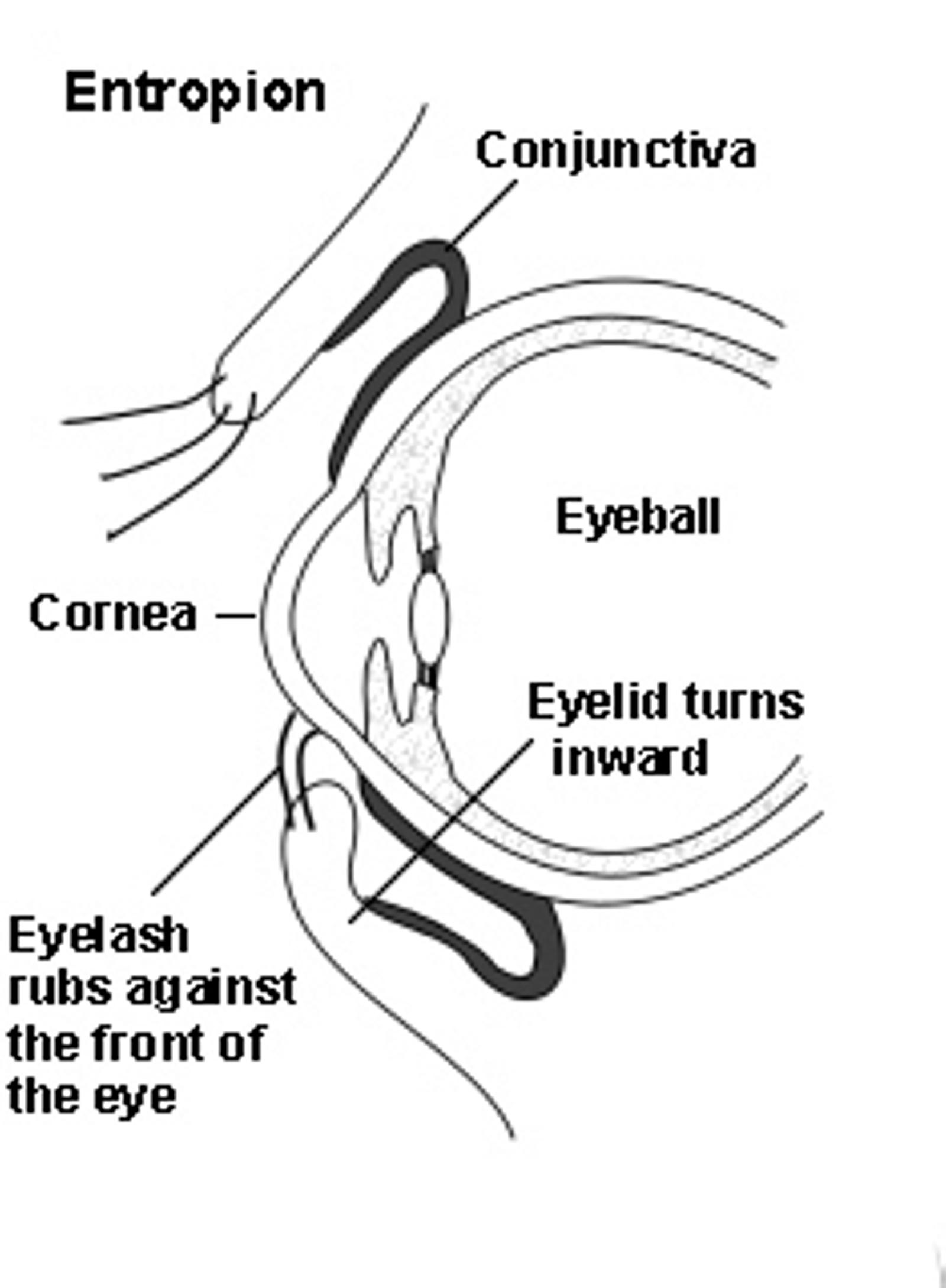 Cross-section diagram of an eye showing an entropion