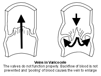 Abnormal vein valves