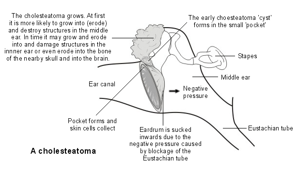 cholesteatoma