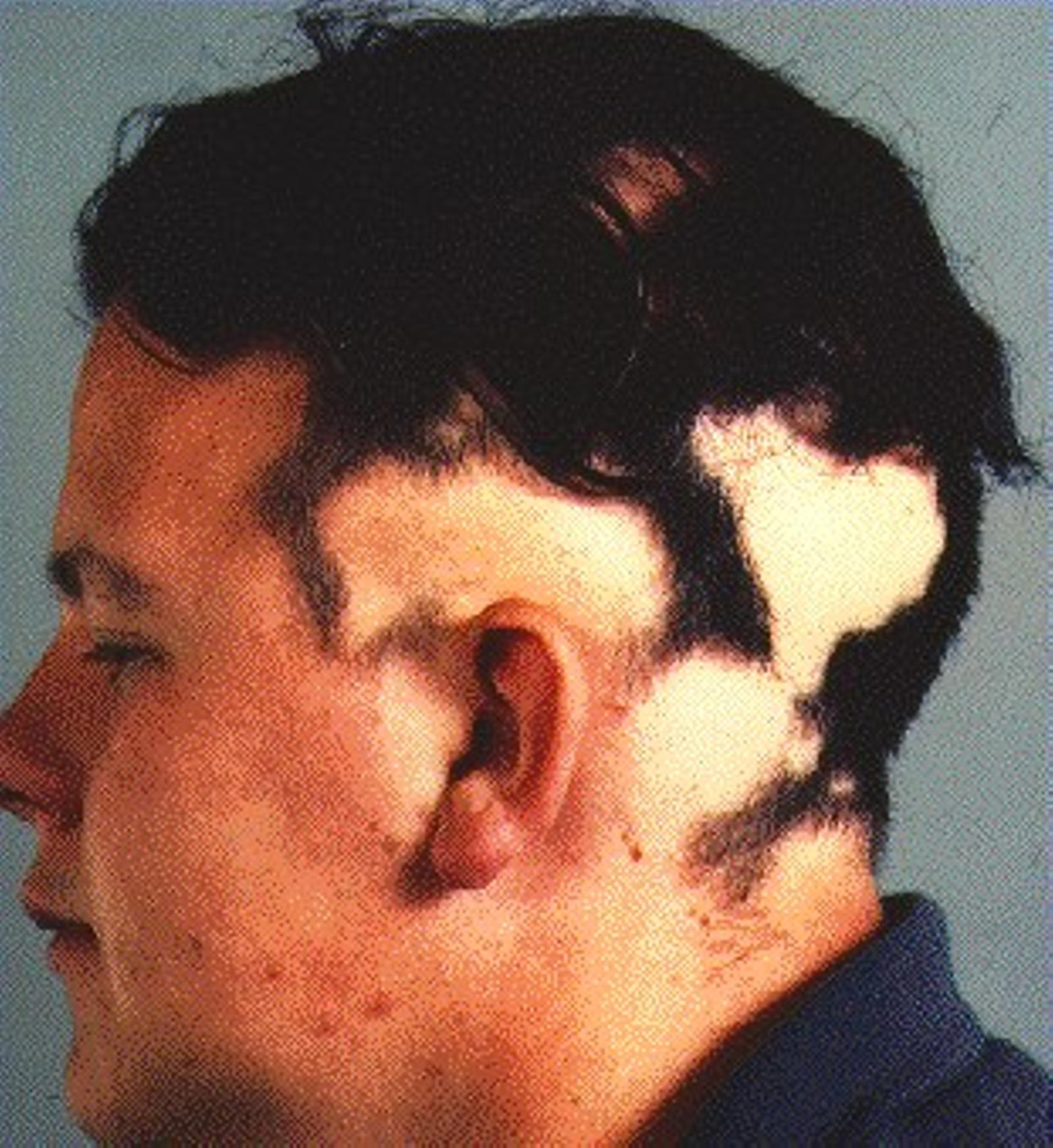 ALOPECIA AREATA - SCALP PATCHES