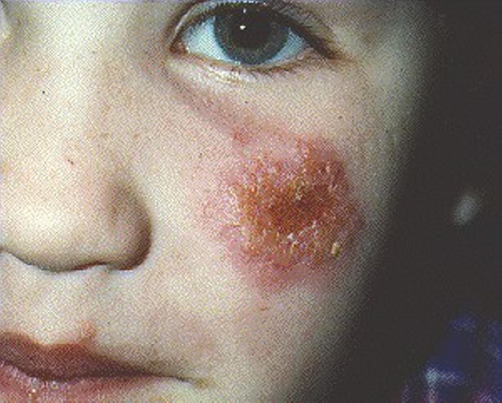 impetigo on child's face