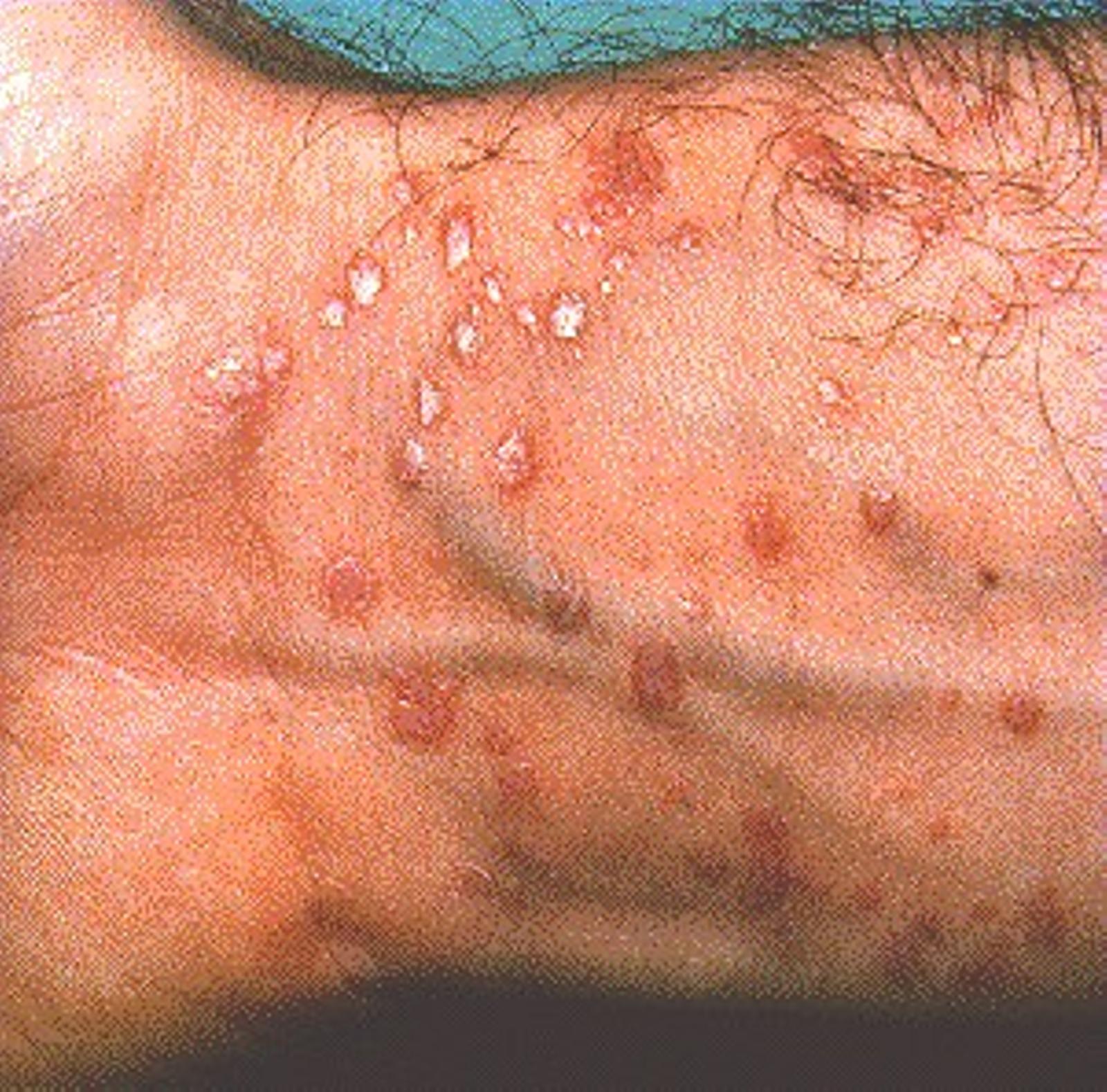 LICHEN PLANUS -ON WRIST