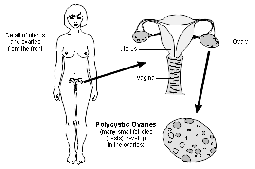 polycystic ovaries