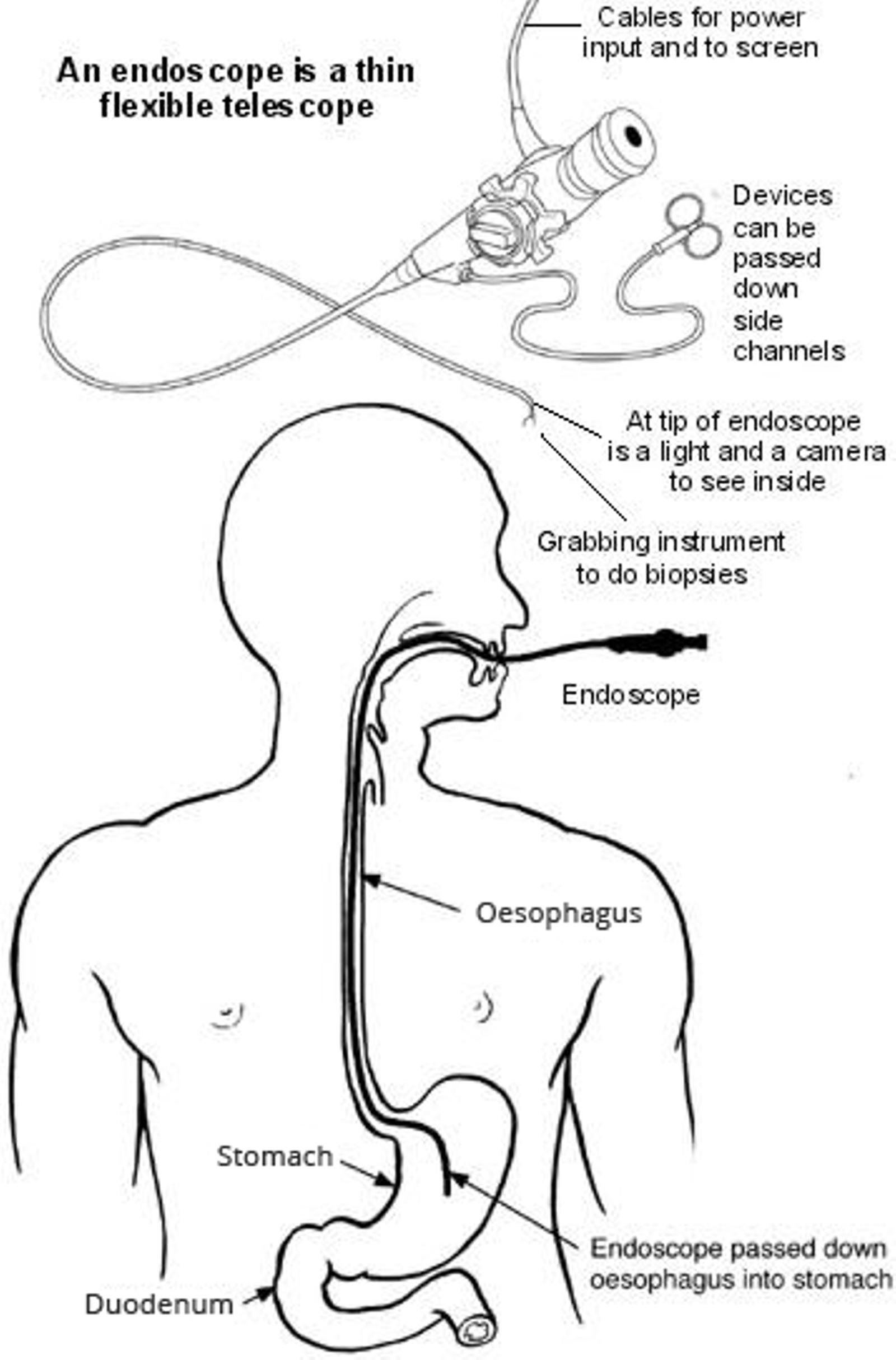 Gastroscopy