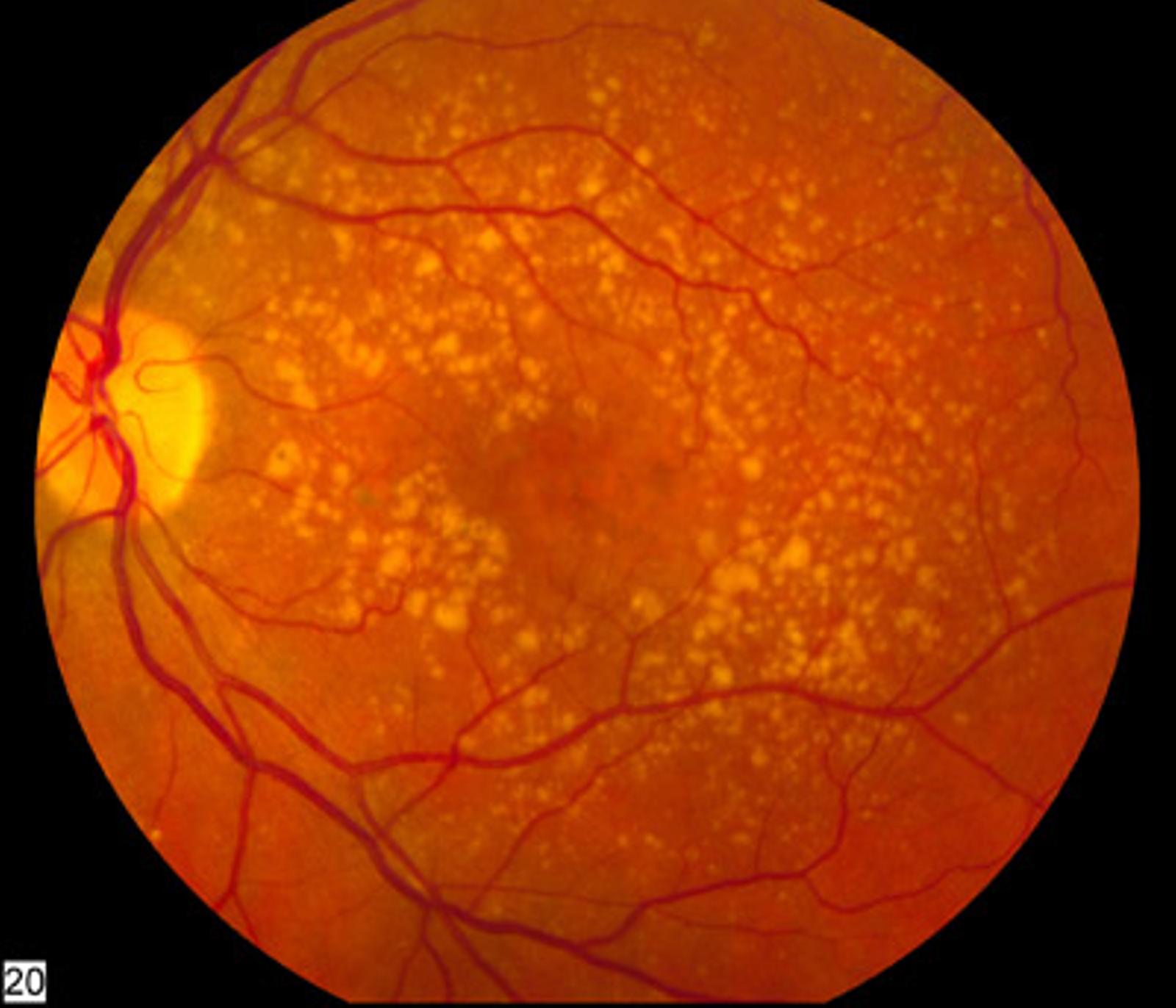 Fundus photo showing dry ARMD