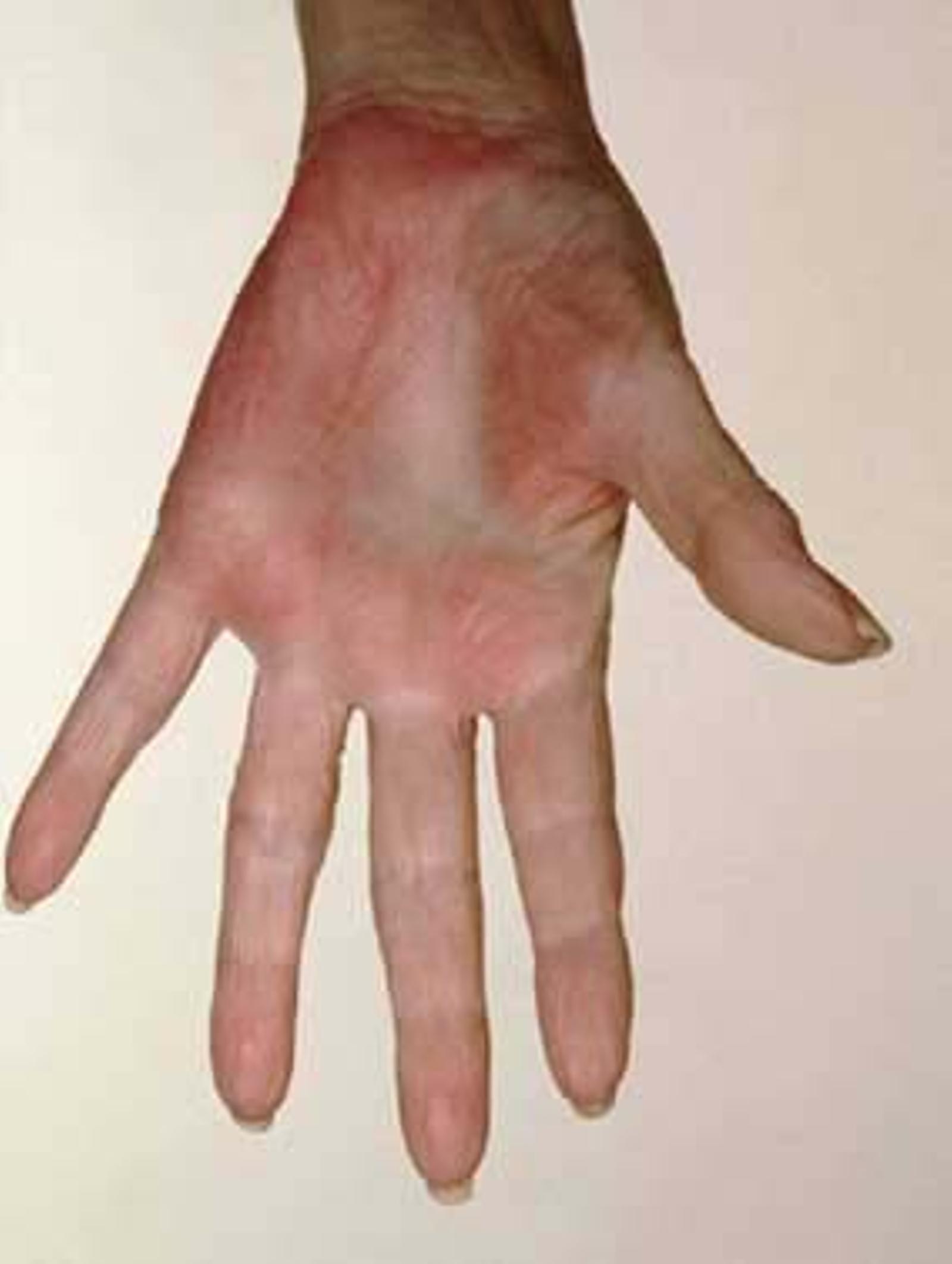 PALMAR ERYTHEMA